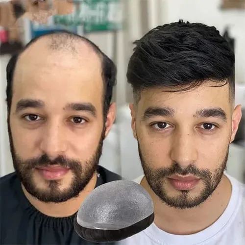 Hair Replacement